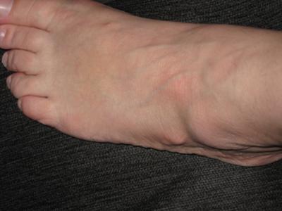 bone growth on side of foot