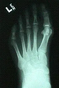 normal_foot_xray