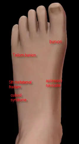 pain on side of foot