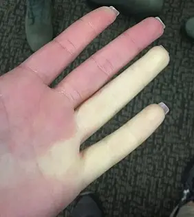 Raynaud in hand