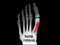 remodeling of great toe joint