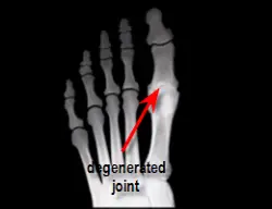 degenerated great toe joint