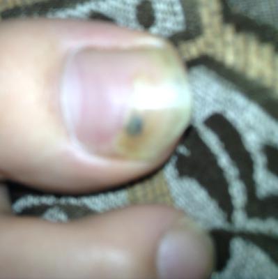 Black Spot Under Nail On Big Toe