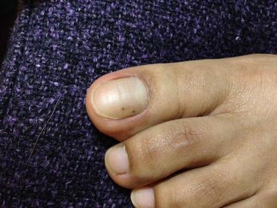 Black Spot Under Toenail