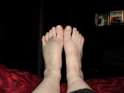Bruisng Swelling And Painful To Touch After I Dropped A Heavy Jar On Top Of My Foot