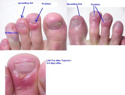 Gout? 2nd Toe Issues?