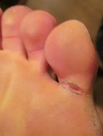 fissures on bottom of feet
