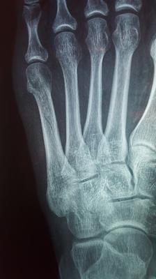 no healing six weeks post fifth metatarsal fracture