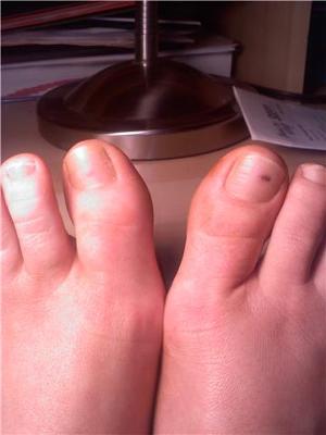 Black Spot Under Big Toenails