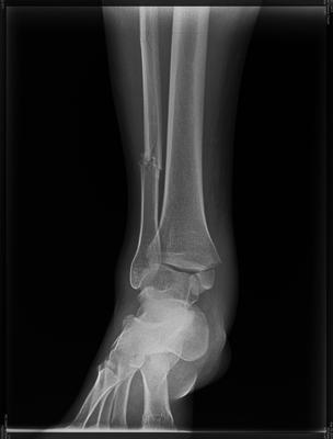 fracture of fibula