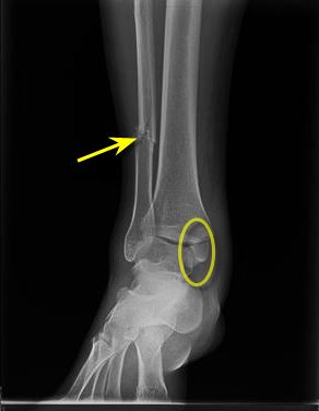 fractured fibula and medial malleolus