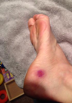 abrasion on heel