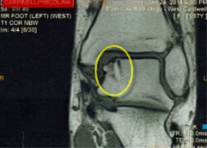 osteochondritis dessicans of talus