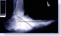 charcot xray of foot