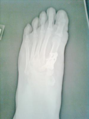 post operative bunion