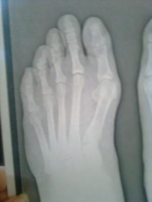 pre-operative bunion