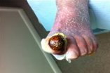 gangrene_of_toe