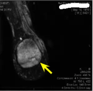 mri heel fracture