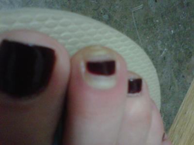 infected runners nails