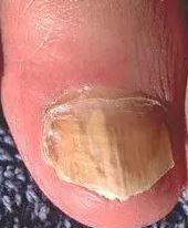 nail fungus