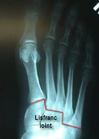 lisfranc_joint