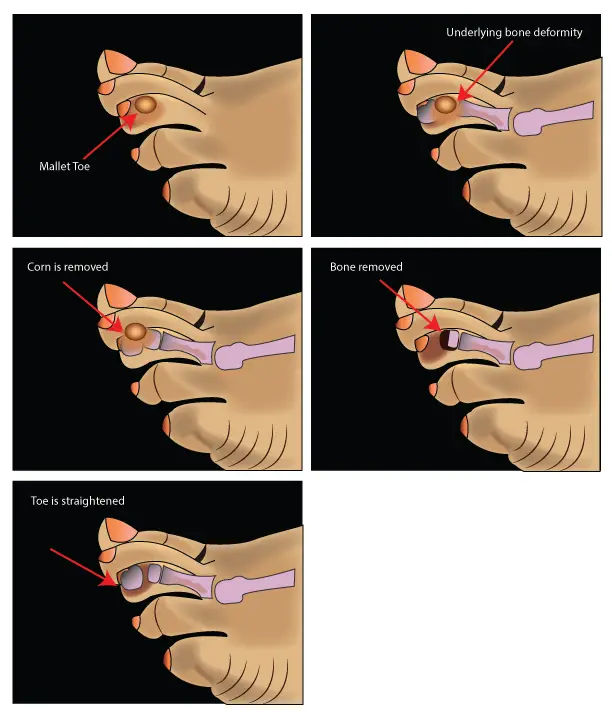 mallet toe surgery