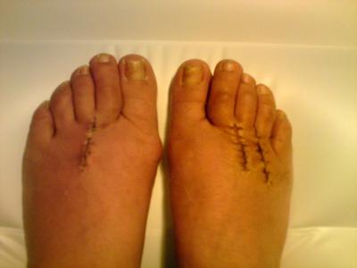 Morton's neuroma surgery