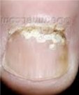 superficial fungus nail