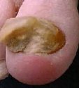 onychomycosis