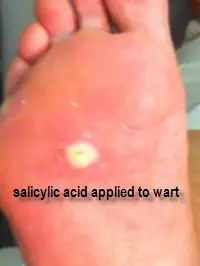 wart treated with salicylic acid