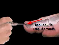 section of bone to be removed in subungual exostosis