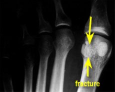 sesamoid fracture xray