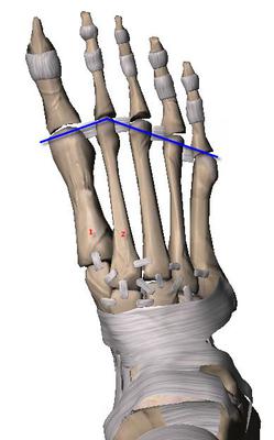 metatarsal parabola and bunion surgery