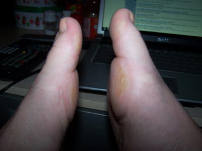 This shows the swelling on the right foot