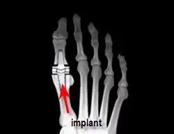 Insertion of Swanson total implant