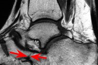 calcaneal-navicular-coalition