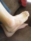 four weeks after lateral ankle sprain