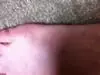 foot trauma