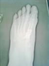 post operative bunion