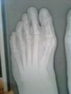 pre-operative bunion