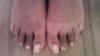 Both feet are different from hammertoe surgery